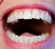 aparitia bacteriilor cavitatii bucale