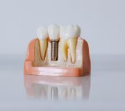 Implanturi dentare in Bucuresti