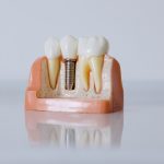 Implanturi dentare in Bucuresti
